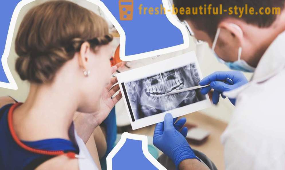 4 kérdés fogászati ​​implantátumok
