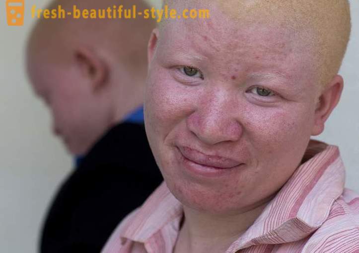 A tragikus története tanzániai albínók