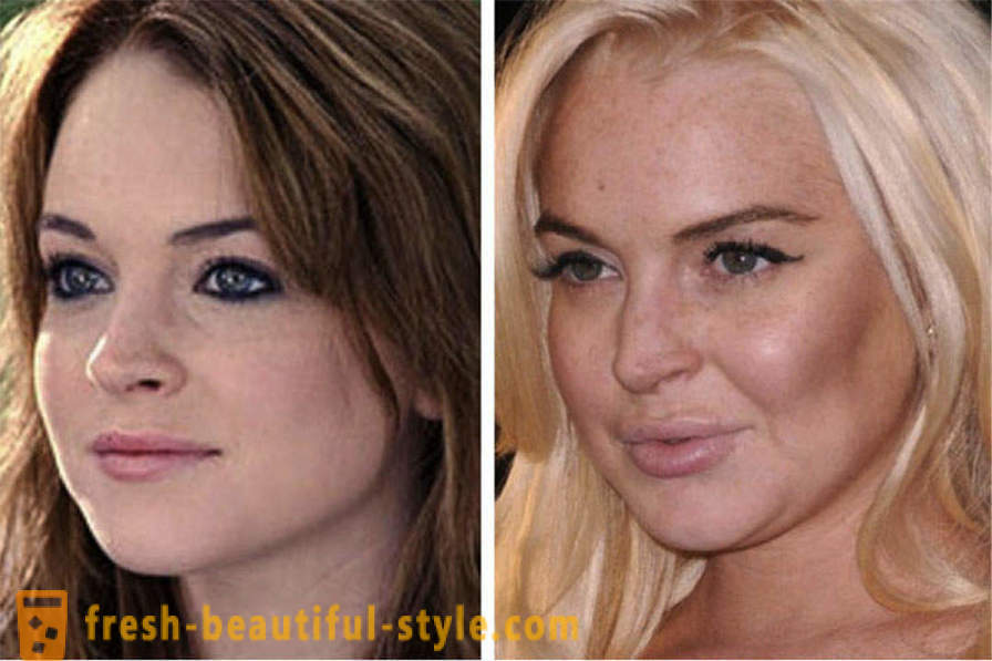 15 híresség, kész rosszul Botox