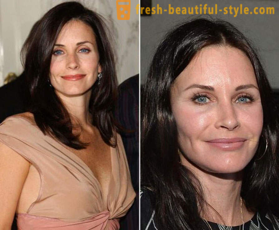 15 híresség, kész rosszul Botox