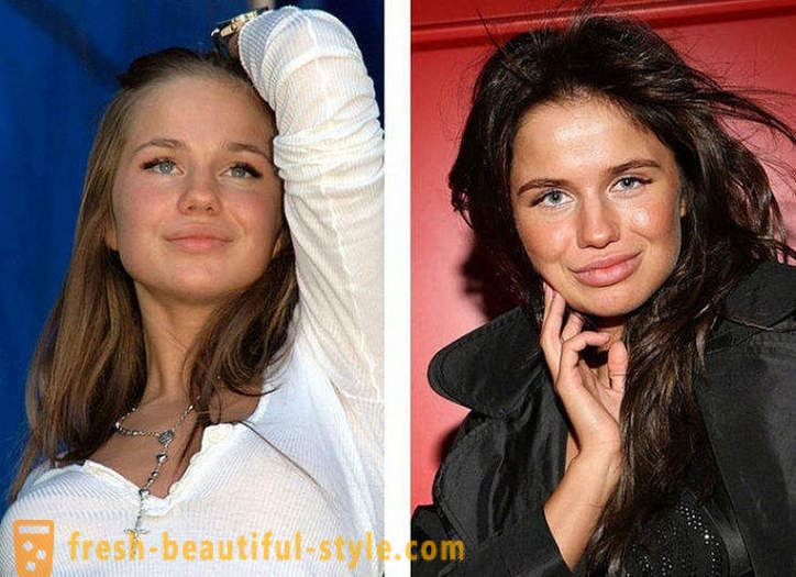 10 orosz szépségek előtt és után plasztikai