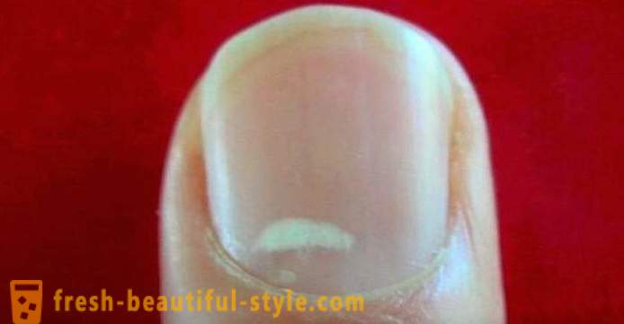 Fehér foltok a körmön az ujjak: okai és kezelési