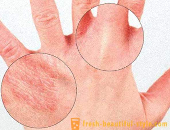 Száraz bőr kéz: okoz. Nagyon száraz bőr, mit kell tenni?