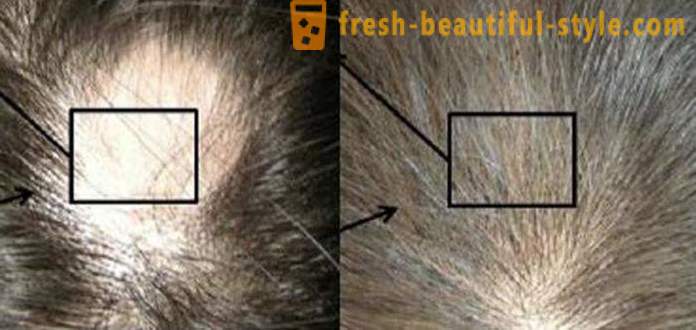 Mezoterápia haj: smink eszközök és ellenjavallatok