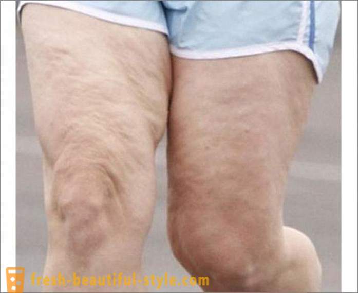 Hogyan lehet megszabadulni a cellulitisz lába? Gyakorlatok a lábak a narancsbőr
