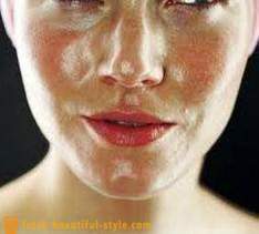 Zsíros bőr arc: mit kell tenni, hogy a probléma kezelésére?