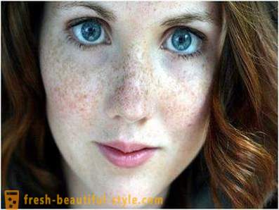 Vigyázz a szépség és a fiatalság: okozza pigmentációt az arcon